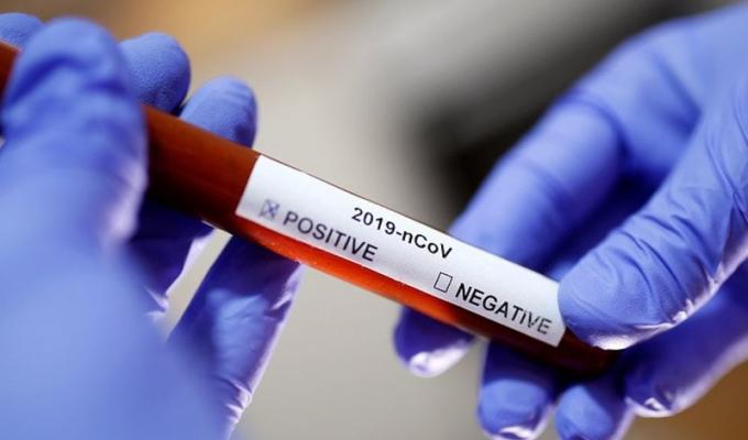 Лабораторно підтверджено 17 нових випадків COVID-19 в області Лабораторно підтверджено 17 нових випадків COVID-19 в області